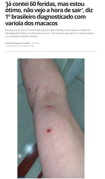 ６０カ所以上にできたという傷を見せる最初の感染者（１１日付Ｇ１サイトの記事の一部）