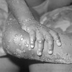 《ブラジル》全国でサル痘患者５人確認＝観察中８人、死亡例は該当しないとの判断