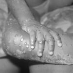 サル痘に感染した４歳女児の右腕と右足に生じた病変。1971年にリベリアで撮影（not listed, Public domain, via Wikimedia Commons）