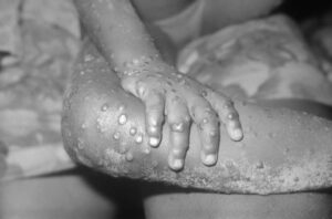 サル痘に感染した４歳女児の右腕と右足に生じた病変。1971年にリベリアで撮影（not listed, Public domain, via Wikimedia Commons）