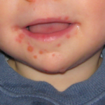 男児の口の周りにできた典型的な病変（ウィキペディア）