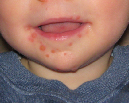 男児の口の周りにできた典型的な病変（ウィキペディア）